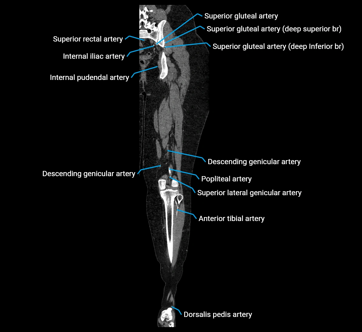 CTA lower limb coronal cross sectional anatomy labelled image _54 (2).webp